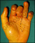 FDP Tendon Avulsion | Jersey Finger 